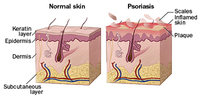 psoriasis-treatment1
