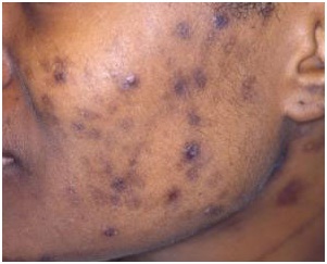 acne pigmentation